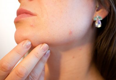 acne-1606765_1920