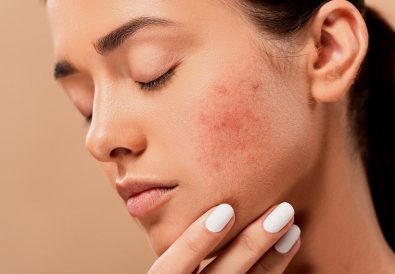 acne-5561750_1280
