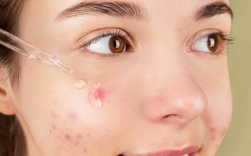 6 Of The Best Ways To Remove Signs Of Scarring